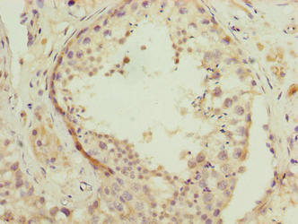 Immunohistochemistry of paraffin-embedded human colon cancer using CAC10495 at dilution of 1:100