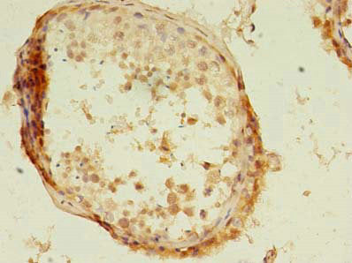 Immunohistochemistry of paraffin-embedded human breast cancer using CAC10542 at dilution of 1:100