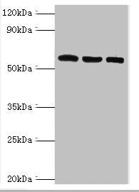 Immunohistochemistry of paraffin-embedded human breast cancer using CAC10638 at dilution of 1:100