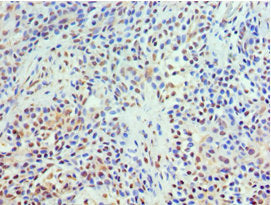 Immunohistochemistry of paraffin-embedded human endometrial cancer using CAC10638 at dilution of 1:100