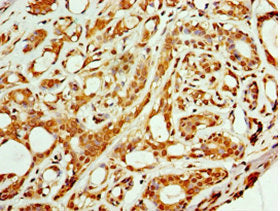 Immunohistochemistry of paraffin-embedded human liver cancer using CAC10669 at dilution of 1:100