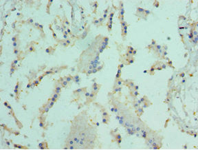 Immunohistochemistry of paraffin-embedded human colon cancer using CAC10696 at dilution of 1:100