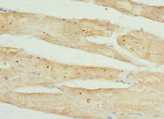 Immunohistochemistry of paraffin-embedded human breast cancer using CAC10712 at dilution of 1:100