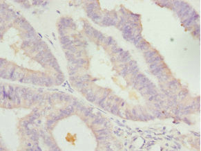 Immunohistochemistry of paraffin-embedded human colon cancer using CAC10719 at dilution of 1: 100