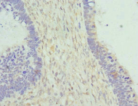 Immunohistochemistry of paraffin-embedded human colon cancer using CAC10724 at dilution of 1:100