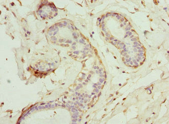 Immunohistochemistry of paraffin-embedded human colon cancer using CAC10734 at dilution of 1:100