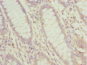Immunohistochemistry of paraffin-embedded human liver cancer using CAC10761 at dilution of 1:100
