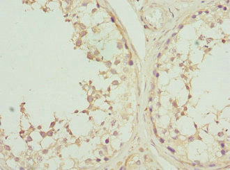 Immunohistochemistry of paraffin-embedded human breast cancer using CAC10771 at dilution of 1:100