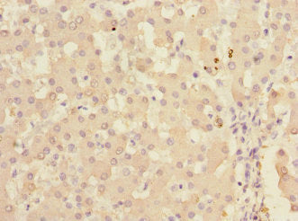Immunohistochemistry of paraffin-embedded human colon cancer using CAC10774 at dilution of 1:100