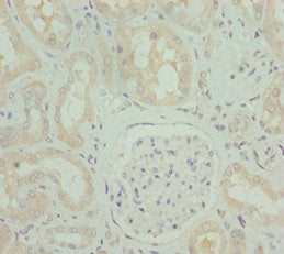 Immunohistochemistry of paraffin-embedded human gastric cancer using CAC10798 at dilution of 1:100
