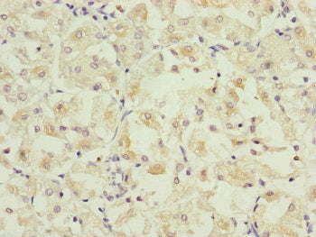 IHC image diluted at 1:325 and staining in paraffin-embedded human liver cancer performed on a Leica BondTM system. After dewaxing and hydration, antigen retrieval was mediated by high pressure in a citrate buffer (pH 6.0). Section was blocked with 10% normal goat serum 30min at RT. Then primary antibody (1% BSA) was incubated at 4°C overnight. The primary is detected by a biotinylated secondary antibody and visualized using an HRP conjugated SP system.