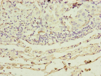 Immunohistochemistry of paraffin-embedded human gastric cancer using CAC10828 at dilution of 1:100