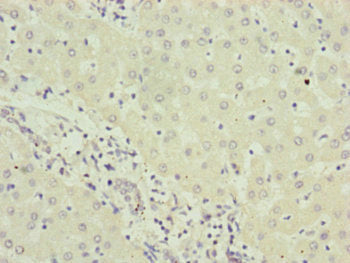 Immunohistochemistry of paraffin-embedded human gastric cancer using CAC10837 at dilution of 1:100