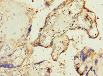 Immunohistochemistry of paraffin-embedded human gastric cancer using CAC10857 at dilution of 1:100