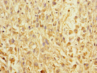 Immunohistochemistry of paraffin-embedded human colon cancer using CAC10910 at dilution of 1:100