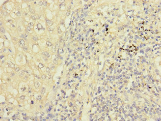 Immunohistochemistry of paraffin-embedded human prostate cancer using CAC10912 at dilution of 1:100