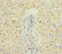 Immunohistochemistry of paraffin-embedded human colon cancer using CAC10922 at dilution of 1:100