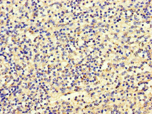 Immunohistochemistry of paraffin-embedded human gastric cancer using CAC10948 at dilution of 1:100