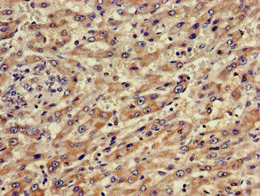 Immunohistochemistry of paraffin-embedded human colon cancer using CAC11050 at dilution of 1:100