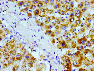 Immunohistochemistry of paraffin-embedded human liver cancer using CAC11188 at dilution of 1:100