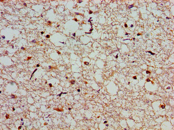 Immunohistochemistry of paraffin-embedded human pancreatic cancer using CAC11204 at dilution of 1:100