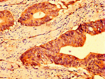 IHC image diluted at 1:500 and staining in paraffin-embedded human liver cancer performed on a Leica BondTM system. After dewaxing and hydration, antigen retrieval was mediated by high pressure in a citrate buffer (pH 6.0). Section was blocked with 10% normal goat serum 30min at RT. Then primary antibody (1% BSA) was incubated at 4°C overnight. The primary is detected by a biotinylated secondary antibody and visualized using an HRP conjugated SP system.