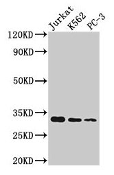 Immunohistochemistry of paraffin-embedded human melanoma using CAC11301 at dilution of 1:100