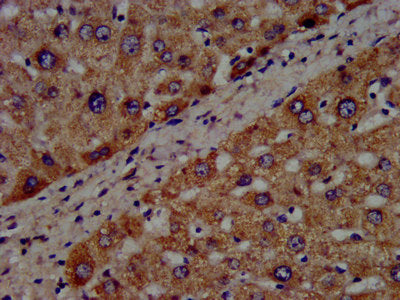 IHC image diluted at 1:300 and staining in paraffin-embedded human liver cancer performed on a Leica BondTM system. After dewaxing and hydration, antigen retrieval was mediated by high pressure in a citrate buffer (pH 6.0). Section was blocked with 10% normal goat serum 30min at RT. Then primary antibody (1% BSA) was incubated at 4°C overnight. The primary is detected by a biotinylated secondary antibody and visualized using an HRP conjugated SP system.