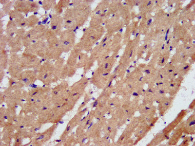 IHC image diluted at 1:200 and staining in paraffin-embedded human endometrial cancer performed on a Leica BondTM system. After dewaxing and hydration, antigen retrieval was mediated by high pressure in a citrate buffer (pH 6.0). Section was blocked with 10% normal goat serum 30min at RT. Then primary antibody (1% BSA) was incubated at 4°C overnight. The primary is detected by a biotinylated secondary antibody and visualized using an HRP conjugated SP system.