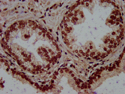 IHC image diluted at 1:500 and staining in paraffin-embedded human pancreatic cancer performed on a Leica BondTM system. After dewaxing and hydration, antigen retrieval was mediated by high pressure in a citrate buffer (pH 6.0). Section was blocked with 10% normal goat serum 30min at RT. Then primary antibody (1% BSA) was incubated at 4°C overnight. The primary is detected by a biotinylated secondary antibody and visualized using an HRP conjugated SP system.