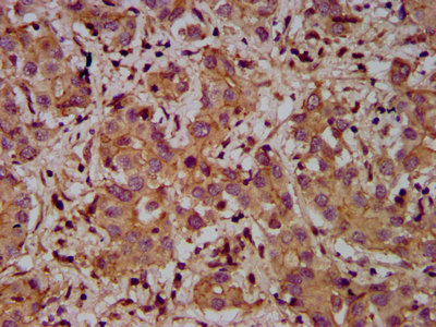 IHC image diluted at 1:400 and staining in paraffin-embedded human pancreatic cancer performed on a Leica BondTM system. After dewaxing and hydration, antigen retrieval was mediated by high pressure in a citrate buffer (pH 6.0). Section was blocked with 10% normal goat serum 30min at RT. Then primary antibody (1% BSA) was incubated at 4°C overnight. The primary is detected by a biotinylated secondary antibody and visualized using an HRP conjugated SP system.