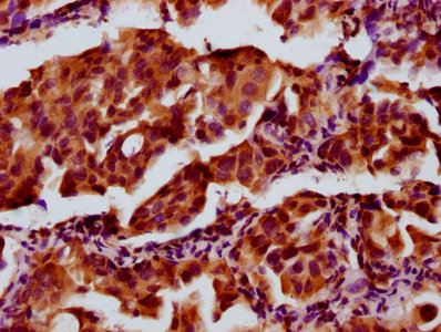 Immunofluorescence staining of MCF-7 cells with CAC11458 at 1:100, counter-stained with DAPI. The cells were fixed in 4% formaldehyde, permeabilized using 0.2% Triton X-100 and blocked in 10% normal Goat Serum. The cells were then incubated with the antibody overnight at 4°C. The secondary antibody was Alexa Fluor 488-congugated AffiniPure Goat Anti-Rabbit IgG(H+L).