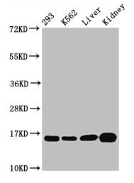 IHC image diluted at 1:20 and staining in paraffin-embedded human lung cancer performed on a Leica BondTM system. After dewaxing and hydration, antigen retrieval was mediated by high pressure in a citrate buffer (pH 6.0). Section was blocked with 10% normal goat serum 30min at RT. Then primary antibody (1% BSA) was incubated at 4°C overnight. The primary is detected by a biotinylated secondary antibody and visualized using an HRP conjugated SP system.
