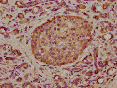 IHC image diluted at 1:300 and staining in paraffin-embedded human liver cancer performed on a Leica BondTM system. After dewaxing and hydration, antigen retrieval was mediated by high pressure in a citrate buffer (pH 6.0). Section was blocked with 10% normal goat serum 30min at RT. Then primary antibody (1% BSA) was incubated at 4°C overnight. The primary is detected by a biotinylated secondary antibody and visualized using an HRP conjugated SP system.