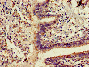Immunohistochemistry of paraffin-embedded human pancreatic cancer using CAC11718 at dilution of 1:100