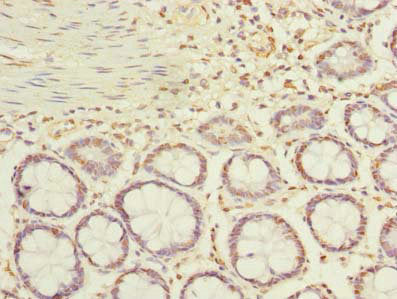 Immunohistochemistry of paraffin-embedded human gastric cancer using CAC11731 at dilution of 1:100