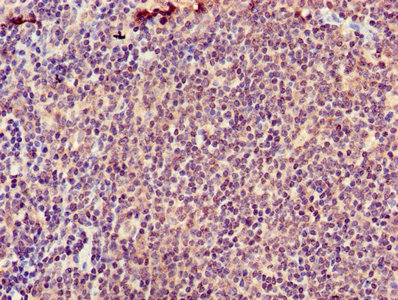 Immunohistochemistry of paraffin-embedded human colon cancer using CAC11757 at dilution of 1:100