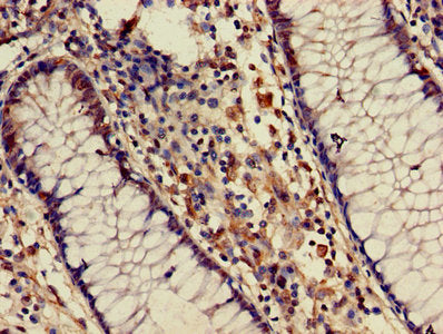 Immunohistochemistry of paraffin-embedded human pancreatic cancer using CAC11757 at dilution of 1:100