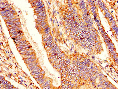 IHC image diluted at 1:400 and staining in paraffin-embedded human pancreatic cancer performed on a Leica BondTM system. After dewaxing and hydration, antigen retrieval was mediated by high pressure in a citrate buffer (pH 6.0). Section was blocked with 10% normal goat serum 30min at RT. Then primary antibody (1% BSA) was incubated at 4°C overnight. The primary is detected by a biotinylated secondary antibody and visualized using an HRP conjugated SP system.