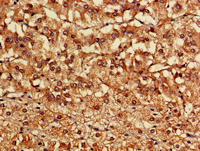 Immunohistochemistry of paraffin-embedded human lung cancer using CAC11784 at dilution of 1:100