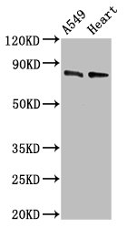 Immunohistochemistry analysis of human cervical cancer using CAC11832 at dilution of 1:100