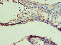Immunohistochemistry of paraffin-embedded human colon cancer using CAC12905 at dilution of 1:100