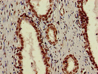 Immunohistochemistry of paraffin-embedded human lung cancer using CAC12912 at dilution of 1:100