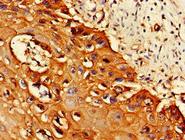 Immunohistochemistry of paraffin-embedded human colon cancer using CAC12918 at dilution of 1:100