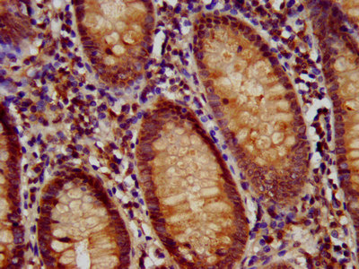IHC image of CAC12921 diluted at 1:700 and staining in paraffin-embedded human lung cancer performed on a Leica BondTM system. After dewaxing and hydration, antigen retrieval was mediated by high pressure in a citrate buffer (pH 6.0). Section was blocked with 10% normal goat serum 30min at RT. Then primary antibody (1% BSA) was incubated at 4°C overnight. The primary is detected by a biotinylated secondary antibody and visualized using an HRP conjugated SP system.