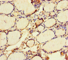 Immunohistochemistry of paraffin-embedded human melanoma using CAC12931 at dilution of 1:100