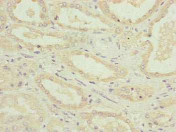 Immunohistochemistry of paraffin-embedded human gastric cancer using CAC12963 at dilution of 1:100