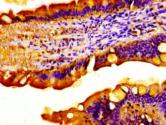Immunohistochemistry of paraffin-embedded human liver cancer using CAC12983 at dilution of 1:100