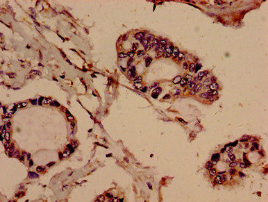 Immunocytochemistry analysis of human liver cancer using CAC13032 at dilution of 1:100