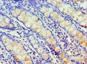 Immunohistochemistry of paraffin-embedded human liver cancer using CAC13060 at dilution of 1:100